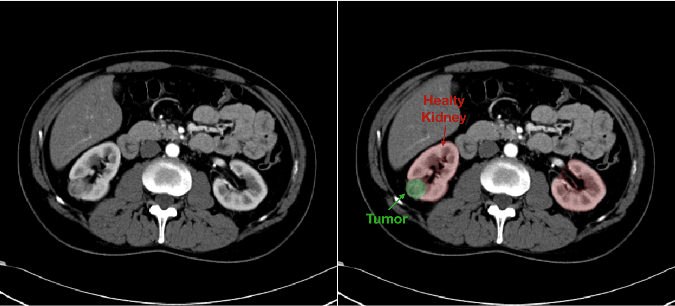 Ai In Medical Imaging The Kidney Tumor Segmentation Challenge