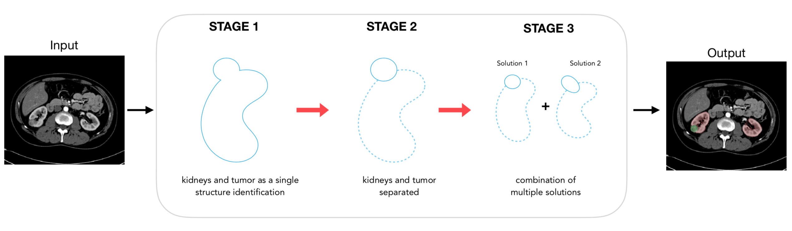 Schematic representation of the system designed to automatically identify and separate the healthy kidney tissue and the tumor.