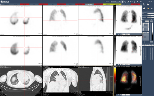 Keo SPECT Pulmo (600ppp)