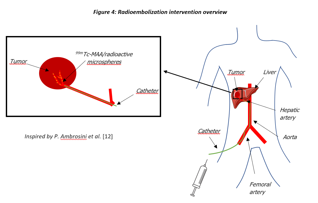 Focus On Selective Internal Radiation Therapy with HCC